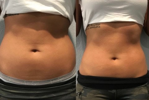 Cryotherapy in Ponte Vedra Beach, FL
