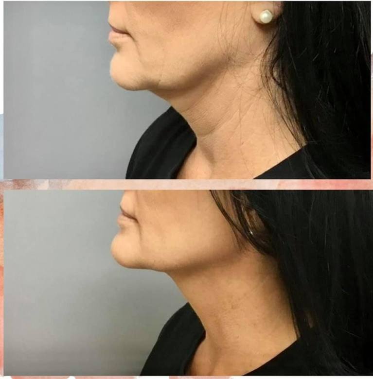 Best Cryo Facial 1 Best Cryo Facial in Ponte Vedra Beach, Florida