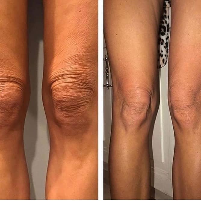 ponte vedra beach cryotoning