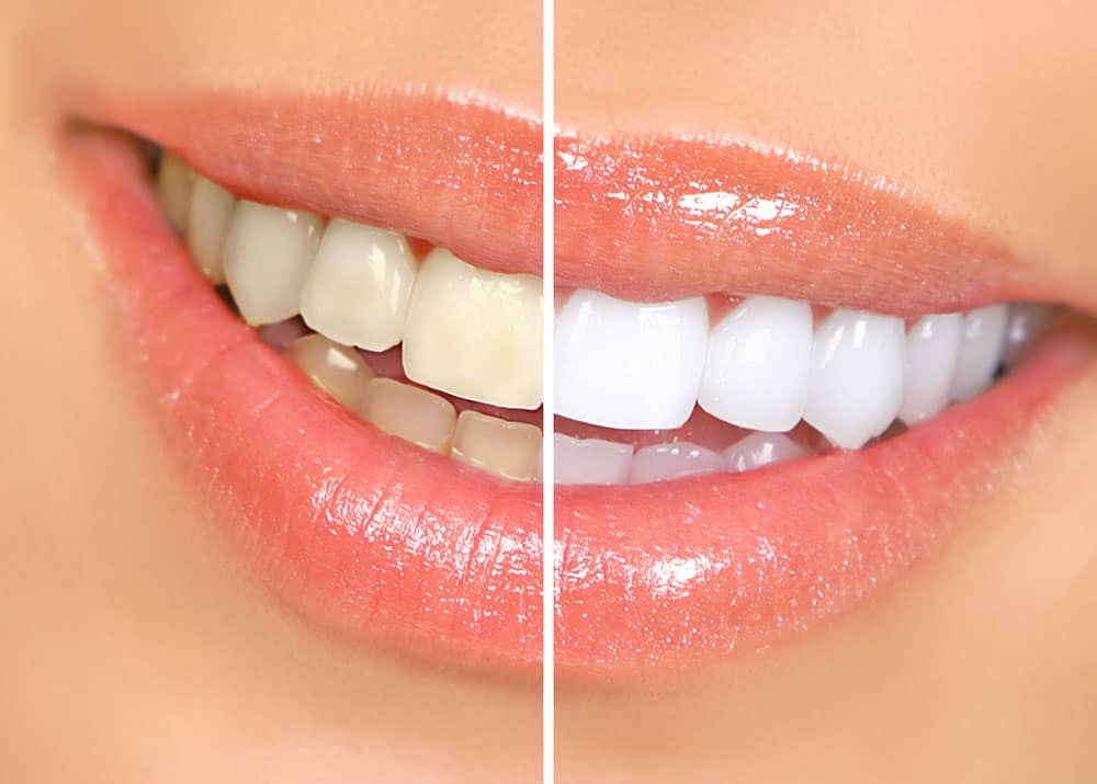 Teeth Whitening Services Ponte Vedra Beach, FL 