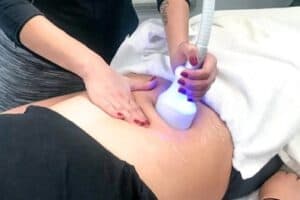 Best Cryo Slimming