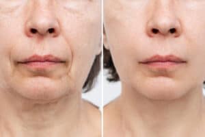 before after wrinkles